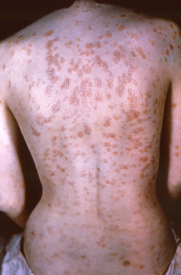 maculopapular rash